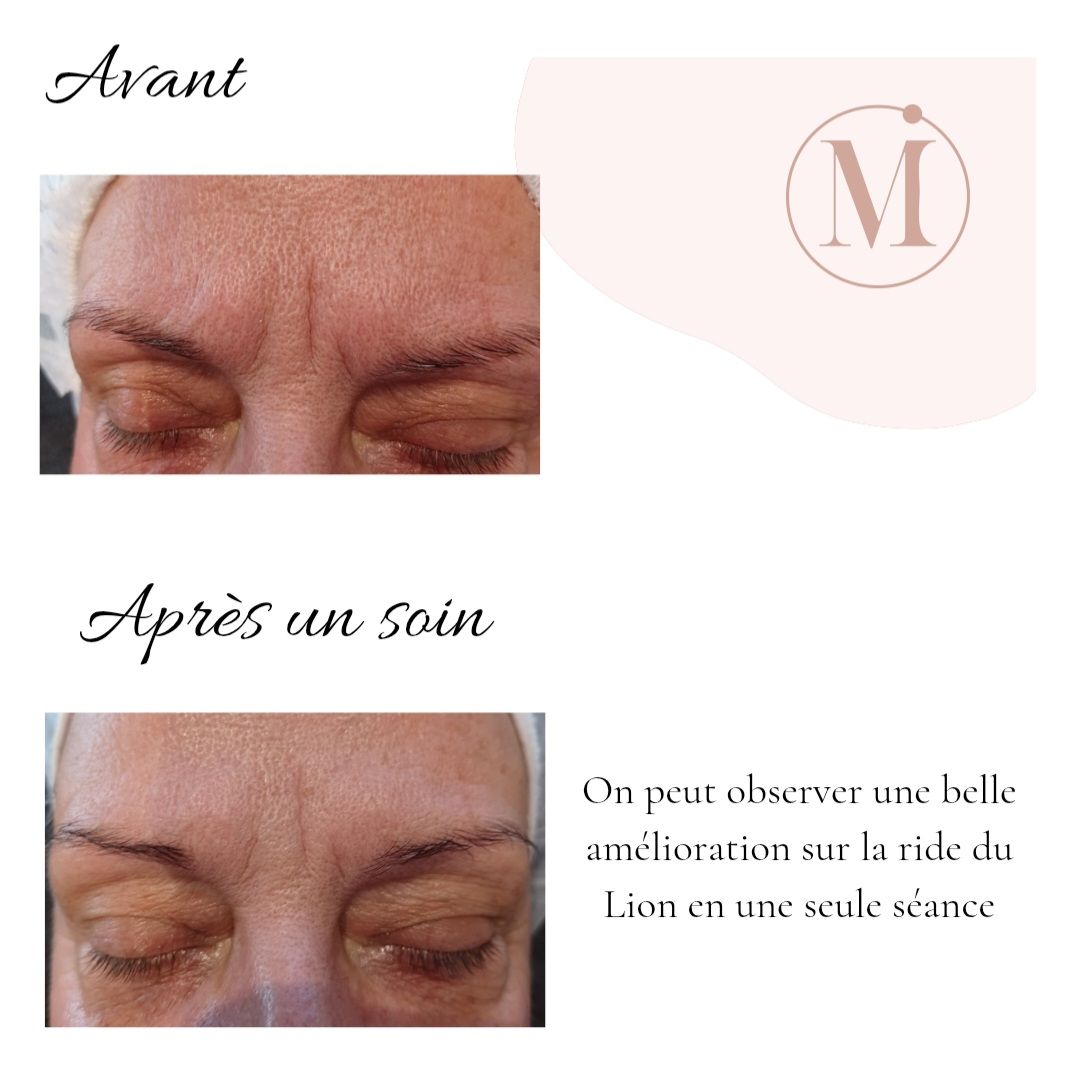 Résultat avant/après soin dermo-esthétique - Transformation de la peau